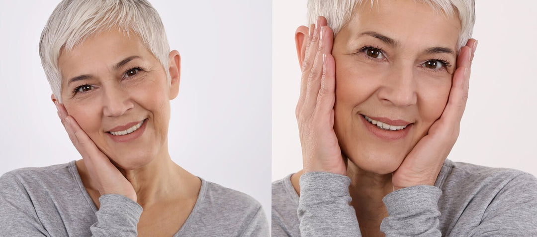 Comment traiter la peau grasse naturellement : Causes et Solutions - Bio-Actif